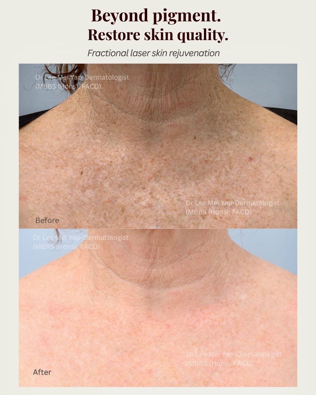 Neck  dcolletage