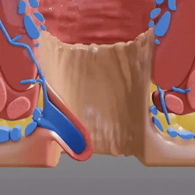 Hemorrhoid Relief Animation