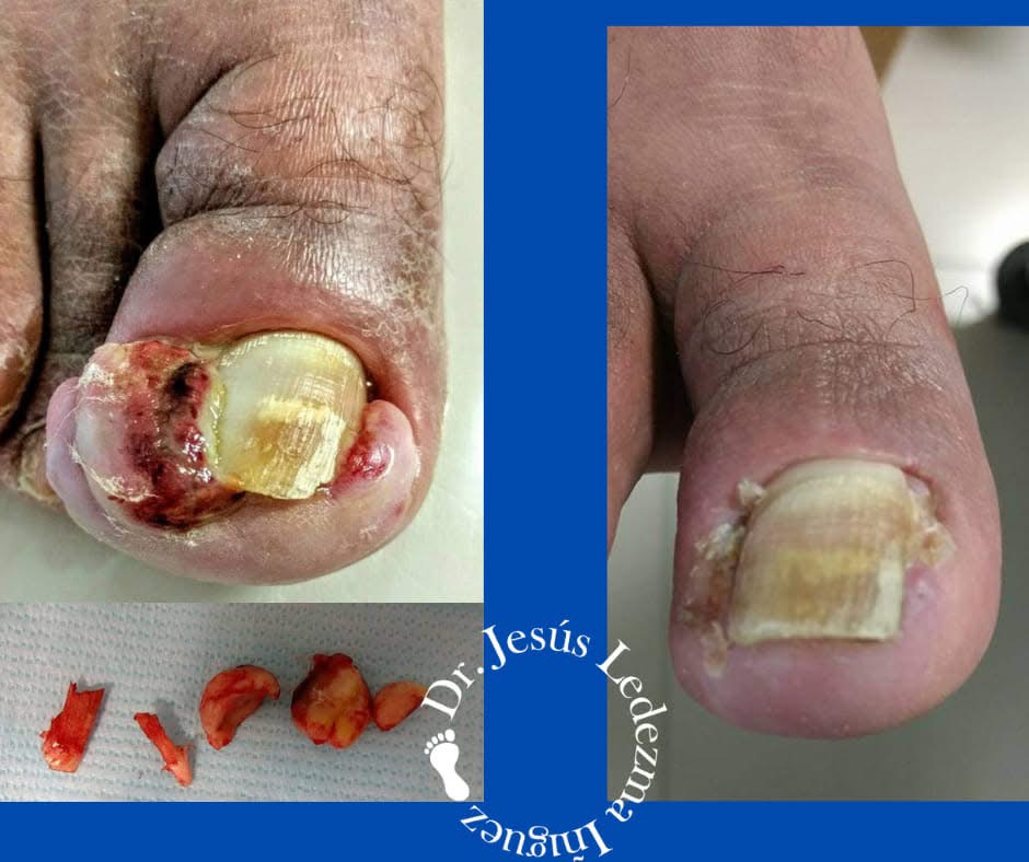 Antes y después de cirugía de uña encarnada — mismo paciente de Podiabetic